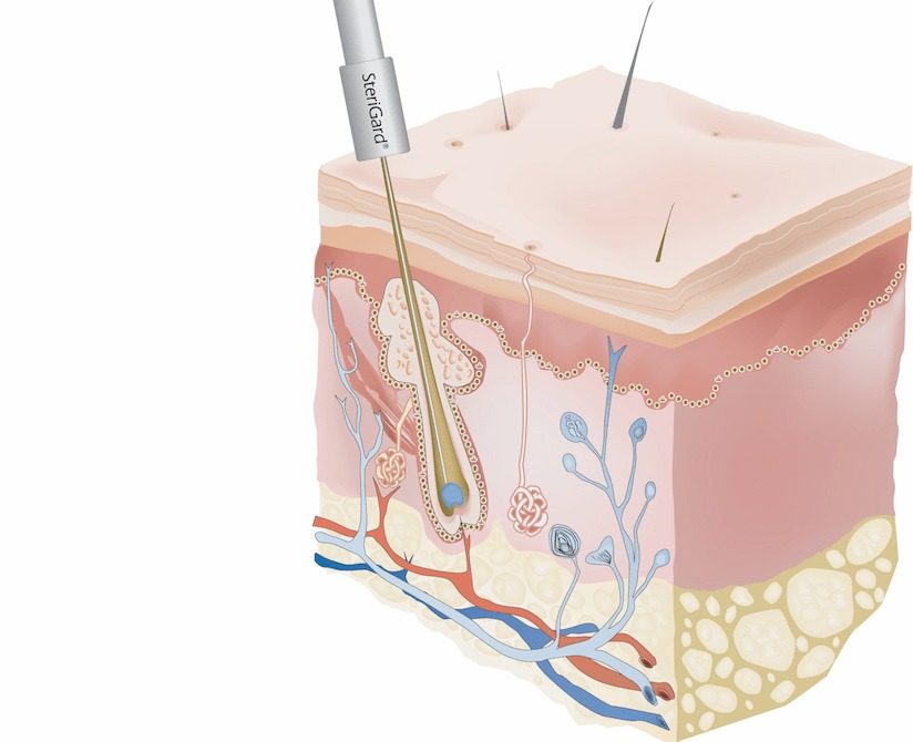 epilationelectroliseapilus centrejowelle sollies centre jowelle sollies pont centre de beauté
